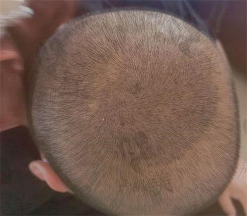 温州新生秃顶植发术后范例