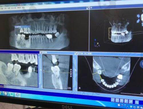 北京维尔口腔医院种植牙
