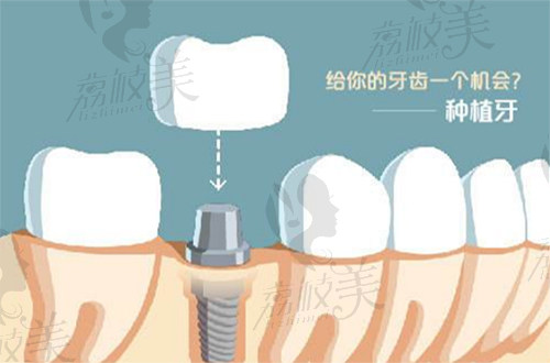 牡丹江种植牙价格收费