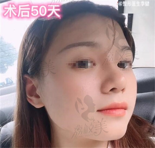 上海華美李健隆鼻術(shù)后50天