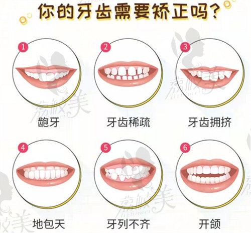 需要牙齒矯正的類型