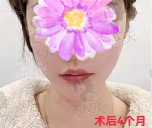 上海时光何晋龙做下颌角术后4个月