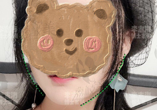 上海华美李志海磨骨术后图