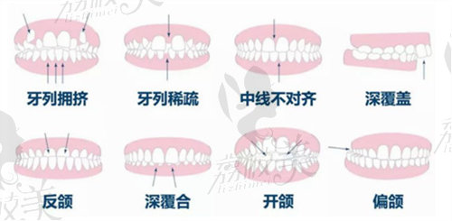 需要牙齿矫正的类型