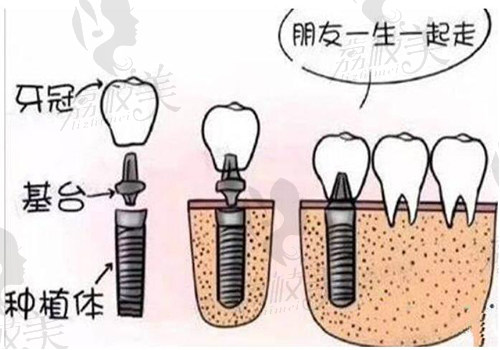 阜阳种植牙一颗多少钱