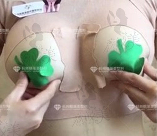 杭州格莱美陈郇做假体隆胸术后图