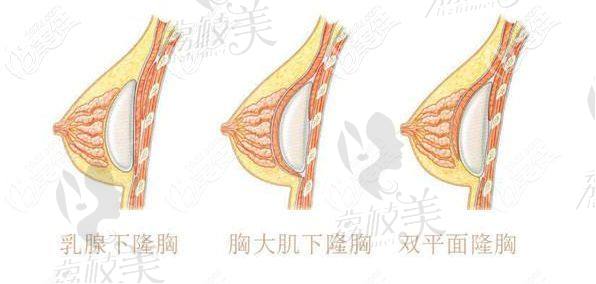 双平面隆胸示意图