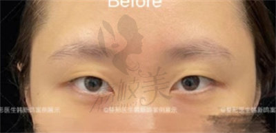 北京眼综合做得好的医生名单曝光，均是排名榜上双眼皮修复牛人