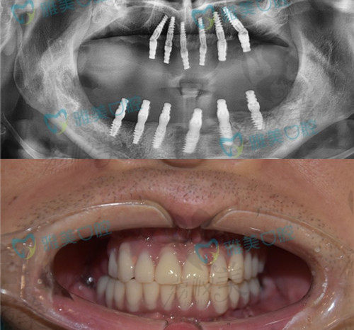 永州雅美口腔全口种植牙