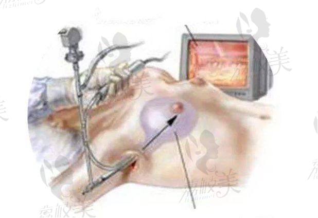 内窥镜隆胸示意图