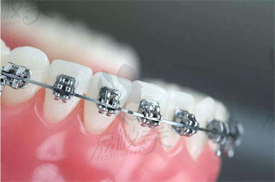高白露医生做牙齿矫正的技术优势2.jpg