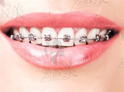 高白露医生做牙齿矫正的技术优势1.jpg