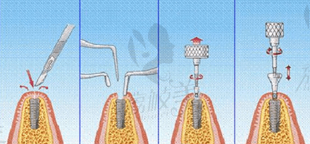 种植牙步骤