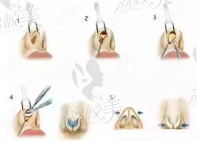 周順波醫(yī)師隆鼻