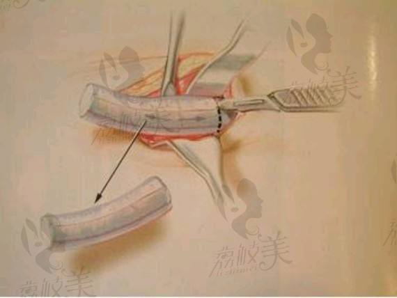 周顺波医师隆鼻