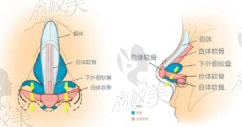 杜太超隆鼻