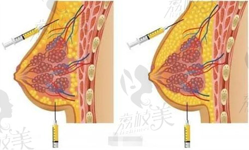 韦元强脂肪丰胸展示