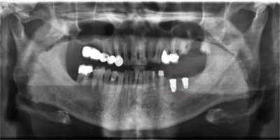 上颌窦内提升种植和上颌窦外提升种植的区别1.jpg