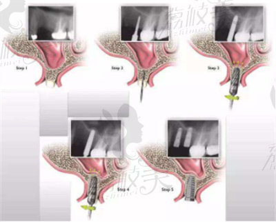 上颌窦内提升种植和上颌窦外提升种植的区别2.jpg