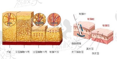 北京华真堂分层吸脂技术