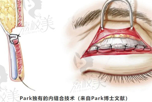 park双眼皮优势