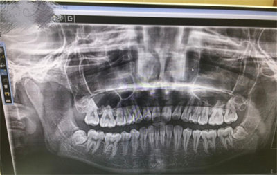 全口无牙颌种植的常见问答1.jpg