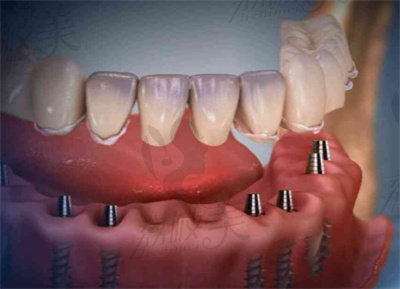 全口无牙颌种植的常见问答2.jpg