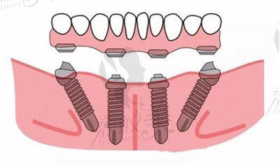 全口无牙颌种植的常见问答12.jpg