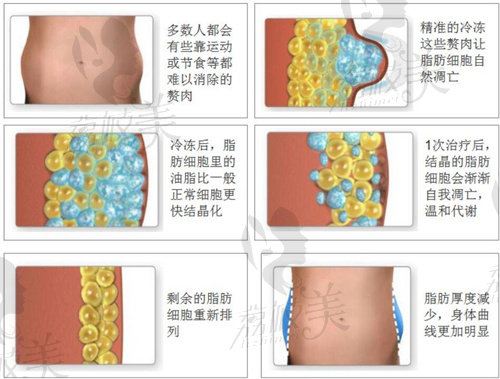 冷冻溶脂减肥靠谱吗？靠谱，国内酷塑官方合作医院名单可在线查询