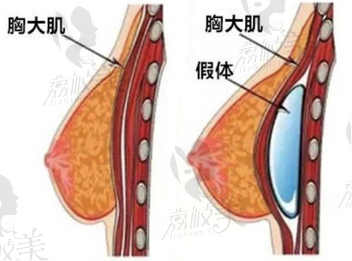 假体隆胸术