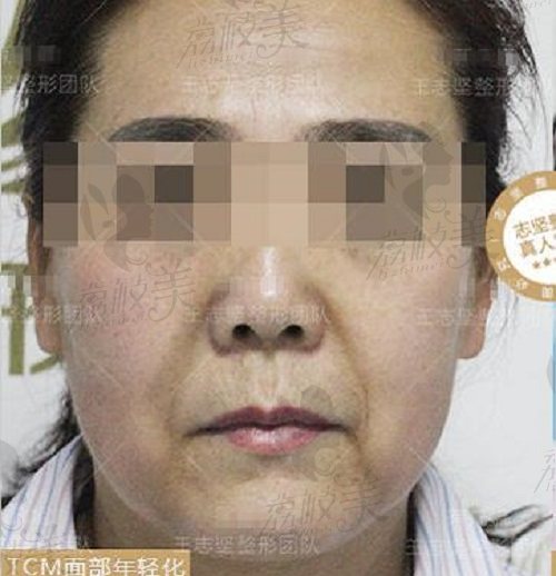 北京京民王志坚的面部拉皮术前图片
