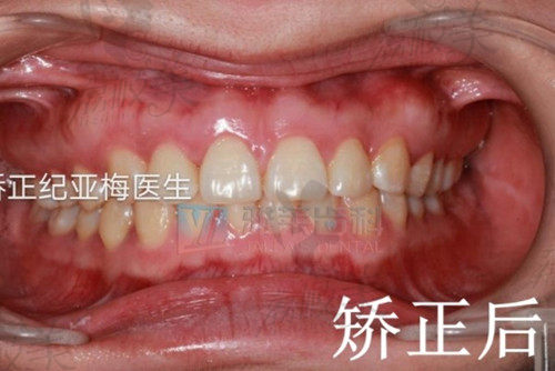 杭州雅莱齿科做牙齿矫正后图