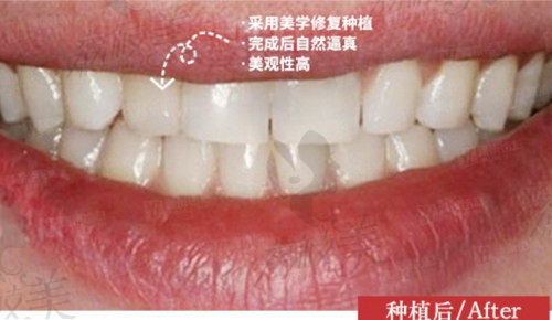 杭州雅莱齿科做种植牙术后图