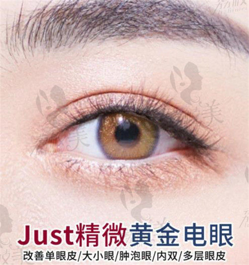 徐丹做双眼皮技术优势