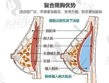 复合隆胸示意图