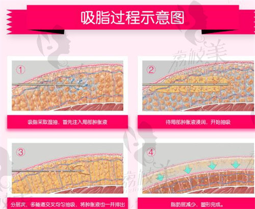 何斌吸脂过程演示