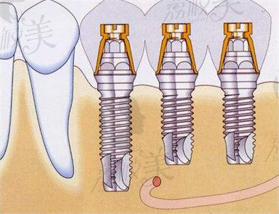 美國(guó)皓圣種植體的特點(diǎn)及優(yōu)勢(shì)1.jpg