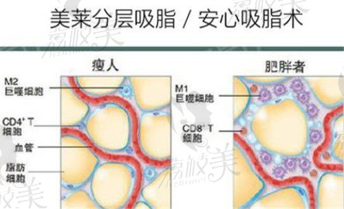 武漢美萊醫(yī)療美容醫(yī)院吸脂優(yōu)勢