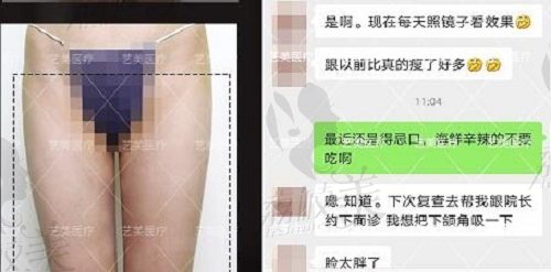 王东大腿吸脂术后反馈及评价