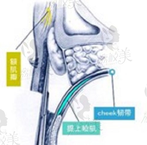 王振军CFS联合筋膜鞘修复上睑下垂