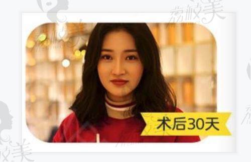 厦门思明海峡医疗美容  双眼皮术后30天