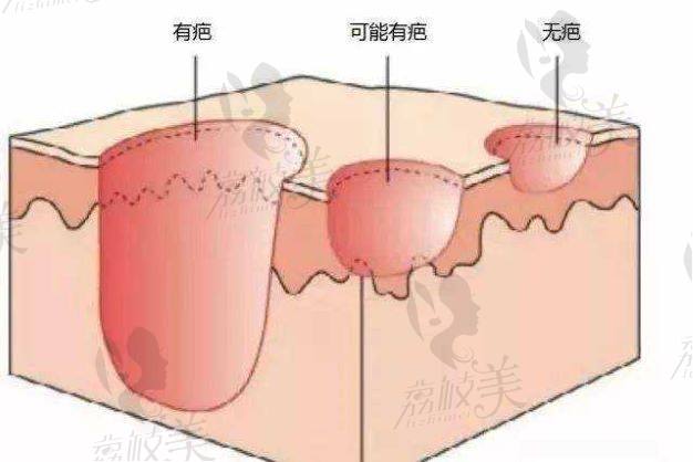 成都疤研疤痕