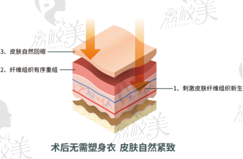 土麦森抽脂的优势