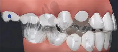 李笑言医生做牙齿矫正的技术优势1
