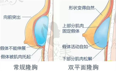 双平面隆胸技术