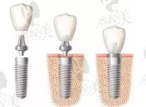 南昌种植牙价格表