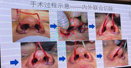 李任医生隆鼻的过程