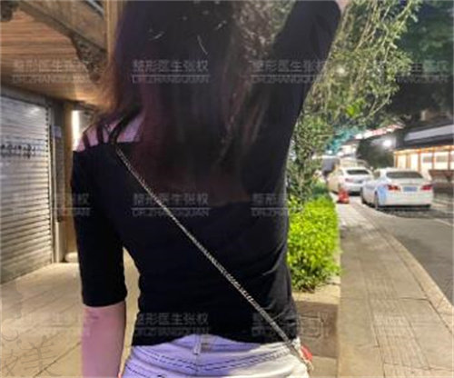 张权肩部吸脂术后1个月