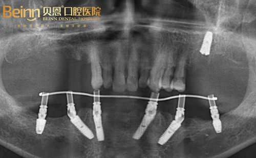 扬州贝恩口腔半口即刻负重种植牙病例