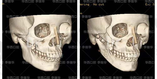 李繼華醫(yī)生做下頜角示意圖